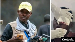 El periodista Jean Marc Jean, reportero del informativo en línea JJM Infos fue alcanzado por una bala de gas lacrimógeno con una herida que provocó la périda de su ojo. [Fotocomposición: Cortesía AmeriqueInfo7]