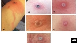 This image provided by the Alaska Department of Health shows several Alaskapox lesions. (Alaska Department of Health via AP)