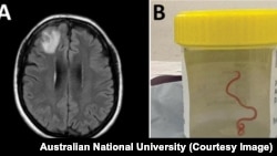An 8-centimeter worm has been found alive in the brain of a woman in Australia. 