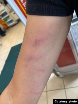 其中一名被襲擊的香港人事後展示傷勢（照片來源：@carmenkamanlau, Carmen Lau 劉珈汶推特帳號）