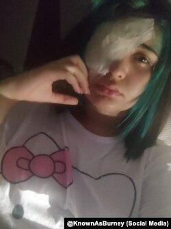 عسل جزیده، نوجوان قربانی شلیک عامدانه ماموران جمهوری اسلامی به چشم معترضان