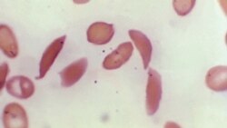 Quiz - US Approves Two Treatments for Sickle Cell Disease