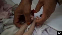 FILE - The stepmother of Mohammed, 4 months old, who is malnourished, holds his legs in the Indira Gandhi hospital in Kabul, Afghanistan, Nov. 8, 2021.