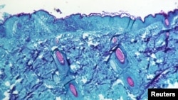 FILE - A section of skin tissue, harvested from a lesion on the skin of a monkey, that had been infected with monkeypox virus, is seen at 50X magnification on day four of rash development in 1968. (CDC/Handout via Reuters)