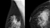 Study Finds Google System Could Improve Breast Cancer Detection