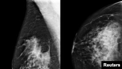 A yellow box indicates where an artificial intelligence (AI) system found cancer hiding inside breast tissue, in an undated photo released by Northwestern University in Chicago, Jan. 1, 2020. 