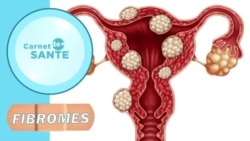 Carnet de santé : que sont les fibromes ?