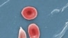 Cameroon Sickle Cell Patients Say They Can Live Longer