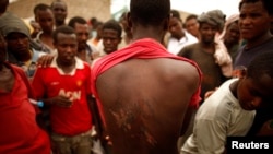 An Ethiopian migrant shows torture wounds he received from traffickers as he waits to be repatriated at a transit center in the western Yemeni town of Haradh, on the border with Saudi Arabia, Mar. 16, 2012.