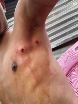 VOA Burmese journalist Htet Aung Khant shows the wound marks left by rubber bullets when he was hit while documenting protests in Mandalay, a city in Myanmar, March 3, 2021. (Htet Aung Khant/VOA Burmese)
