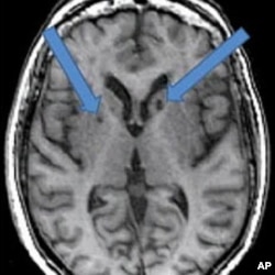 Silent Strokes Tied to Memory Loss Among Older Adults