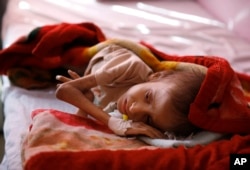 FILE - A malnourished child lies in a bed waiting to receive treatment at a therapeutic feeding center in a hospital in Sana'a, Yemen, Jan. 24, 2016.