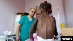 FILE - A nurse reads the scale as he weighs a malnourished girl at a malnutrition treatment center in Sanaa, Yemen, Oct. 7, 2018. 