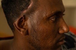 Nigusse Tadele, 29, woke up in a clinic after a bombing. He lost his toes and part of his ear, pictured in Axum, Ethiopia, June 10, 2021. (Yan Boechat/VOA)