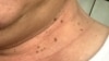 Skin tags