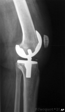 This x-ray shows shows an artificial knee joint, but now scientists are exploring regenerating damaged joints using a patient&#39;s own stem cells.