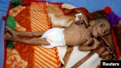 One-year-old Fatima Abdullah Hassan, who suffers from severe malnutrition, lies in bed at a malnutrition treatment center in the Red Sea port city of Hodeida, Yemen.