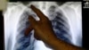 A doctor points to an x-ray showing a pair of lungs infected with TB (tuberculosis) in Ladbroke Grove in London, England, Jan. 27, 2014.