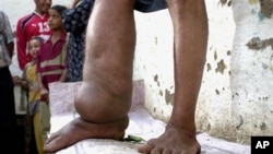 FILE - A leg disfigured by elephantiasis, Egypt, Oct. 3, 2004.