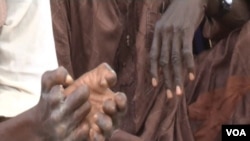 Hands of people handicapped by leprosy, Yaounde, Jan. 21, 2021. (Moki Edwin Kindzeka/VOA)