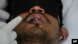 ARCHIVO - Un médico muestra una llaga de viruela del simio en el labio de un paciente, en el hospital Arzobispo Loayza en Lima, Perú, el martes 16 de agosto de 2022. 