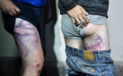 FILE - People detained during rallies of opposition supporters, who accuse Alexander Lukashenko of falsifying the polls in the presidential election, show bruises as they leave the Okrestina prison in Minsk, Aug. 14, 2020.
