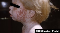 Gambar penyakit Rubella atau Campak Jerman.
