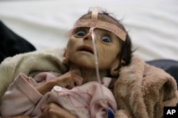 FILE - Infant Udai Faisal, who died from acute malnutrition on March 24, is one of thousands of Yemeni children who are suffering from hunger as one of the most horrific consequence of the Yemeni conflict and the naval blockade and airstrikes by the Saudi-led coaltion.