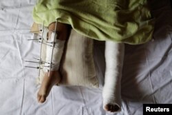 Culinary student Brian Dalati, 22, a bystander who was injured during a protest against Venezuela's President Nicolas Maduro's government, poses for a photograph inside his home in Caracas, Venezuela, Aug. 15, 2017.