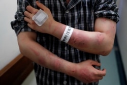 FILE - Calvin So, a victim of the Yuen Long attacks, shows his wounds at a hospital, in Hong Kong, China, July 22, 2019.