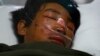 Dawa Tashi Sherpa in the Intensive Care Unit of Grandi International Hospital, Dhapasi, Kathmandu, April 18, 2014.