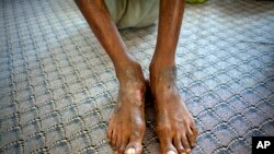 A man suspected of being a Gadhafi loyalist shows wounds on his feet at a detention facility in Misrata, Libya, Sept. 22, 2011.