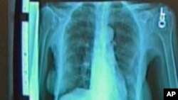 Periset mendapati penderita bronkitis kronis, pembengkakan paru-paru atau pneumonia memiliki risiko lebih tinggi menderita kanker paru-paru (foto: ilustrasi). 