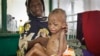 Abdulahi Musa, a malnourished five-year-old boy, sits on his mother's lap at Banadir hospital in Mogadishu, Somalia Tuesday, May 20, 2014. Much of Somalia has seen no or erratic rains in recent months and fighting between African Union forces and the Isl