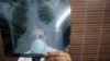 FILE - A physician examines an X-ray picture of a tuberculosis patient.