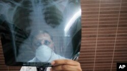 FILE - A physician examines an X-ray picture of a tuberculosis patient.