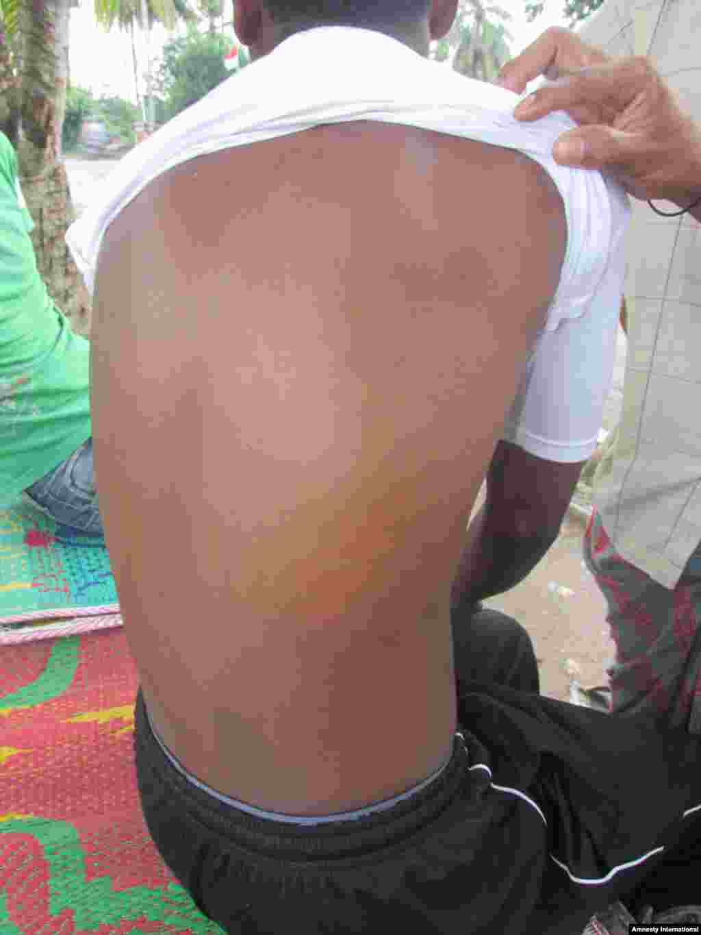 A Bangladeshi man showing scar from boat crew.