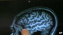Using MR spectroscopy, an MRI-type scan, researchers identified people who may be at risk for developing Alzheimer's.